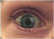 The Horrified Bloodshot Eye! Scary eh?